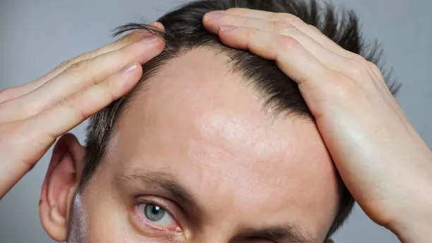 Male Pattern Hair Loss